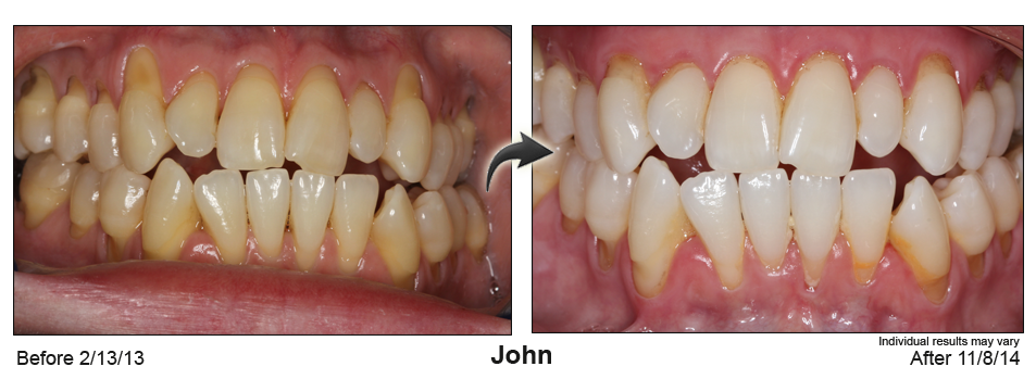 Jacksonville gum recession